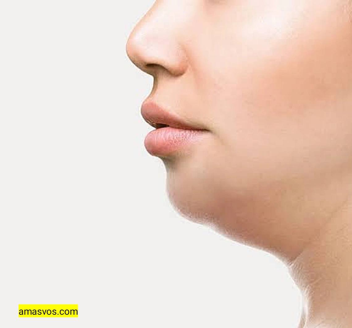 Kybella Swelling Day By Day
