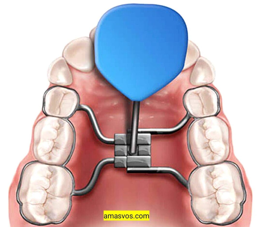 Palate Expander Before And After 2023 Amasvos