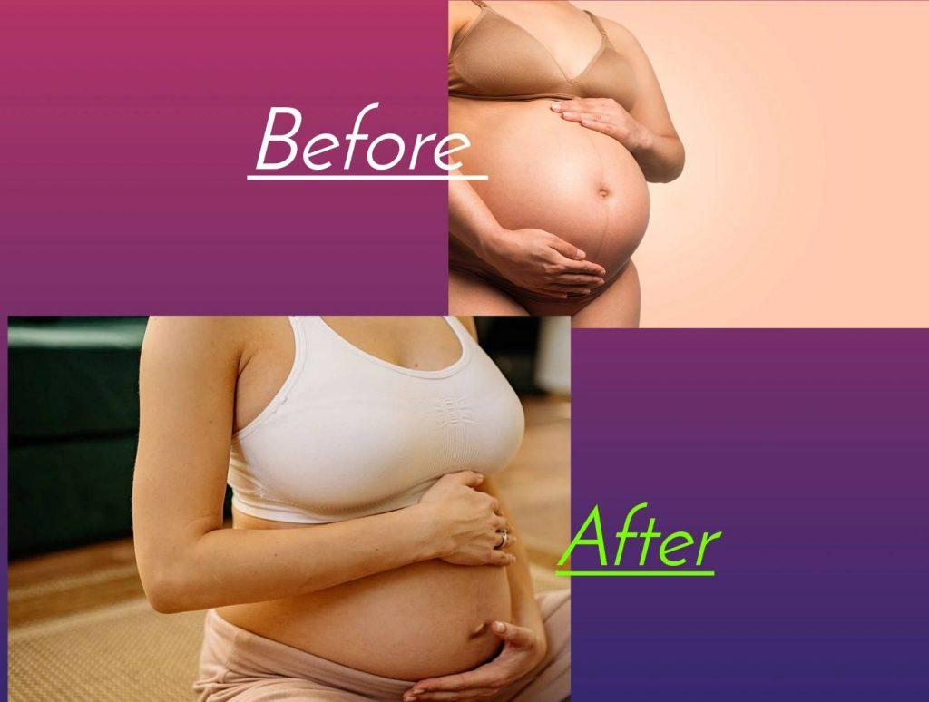 pregnancy-tummy-tuck-before-and-after-images-amasvos