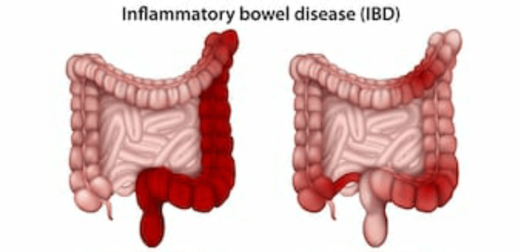 stomach-hurts-while-pooping-the-top-5-hidden-facts